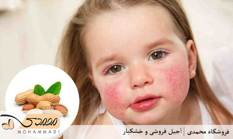 آجیل های با خطر بالای ایجاد آلرژی